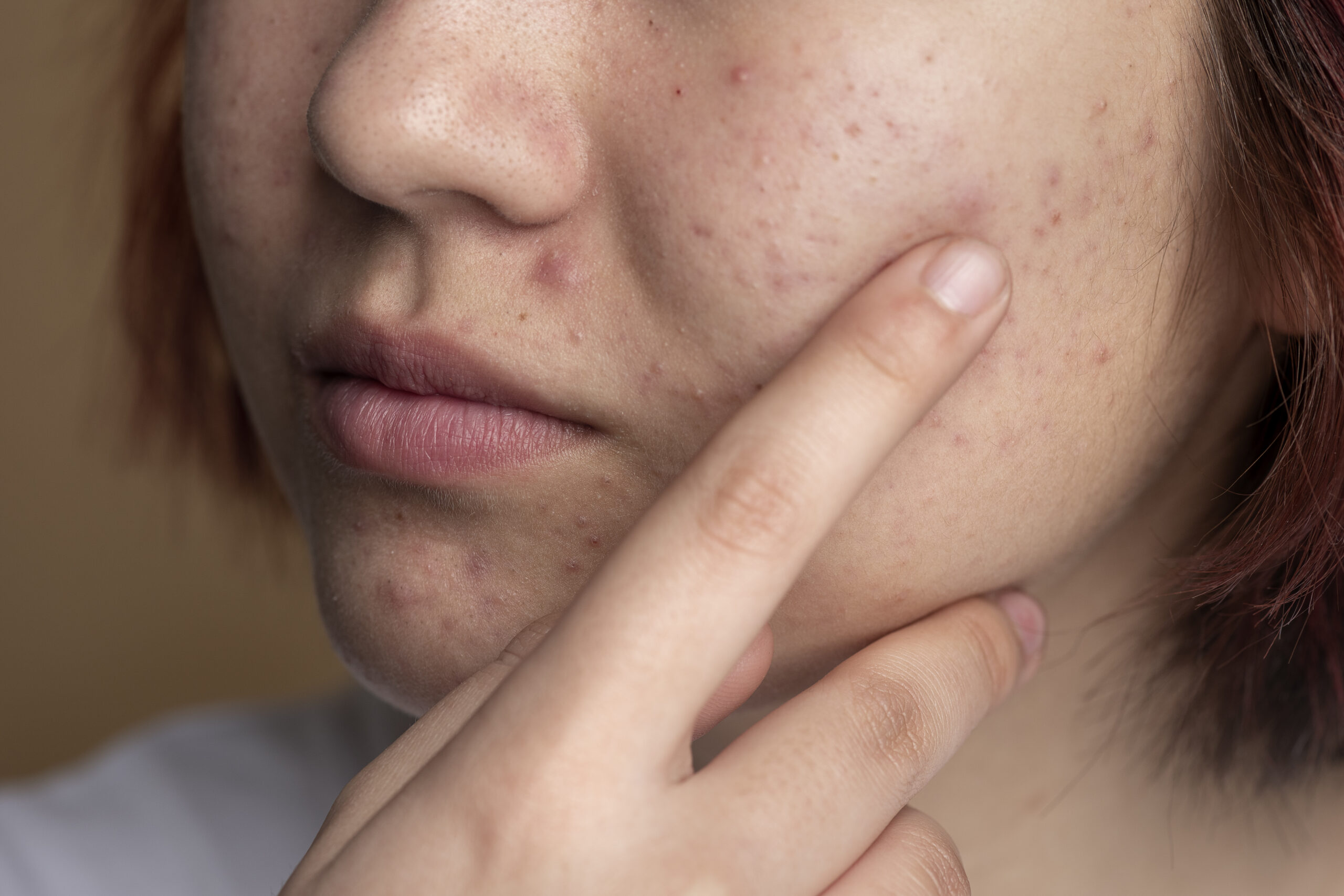 woman's face with breakouts and dark spots
